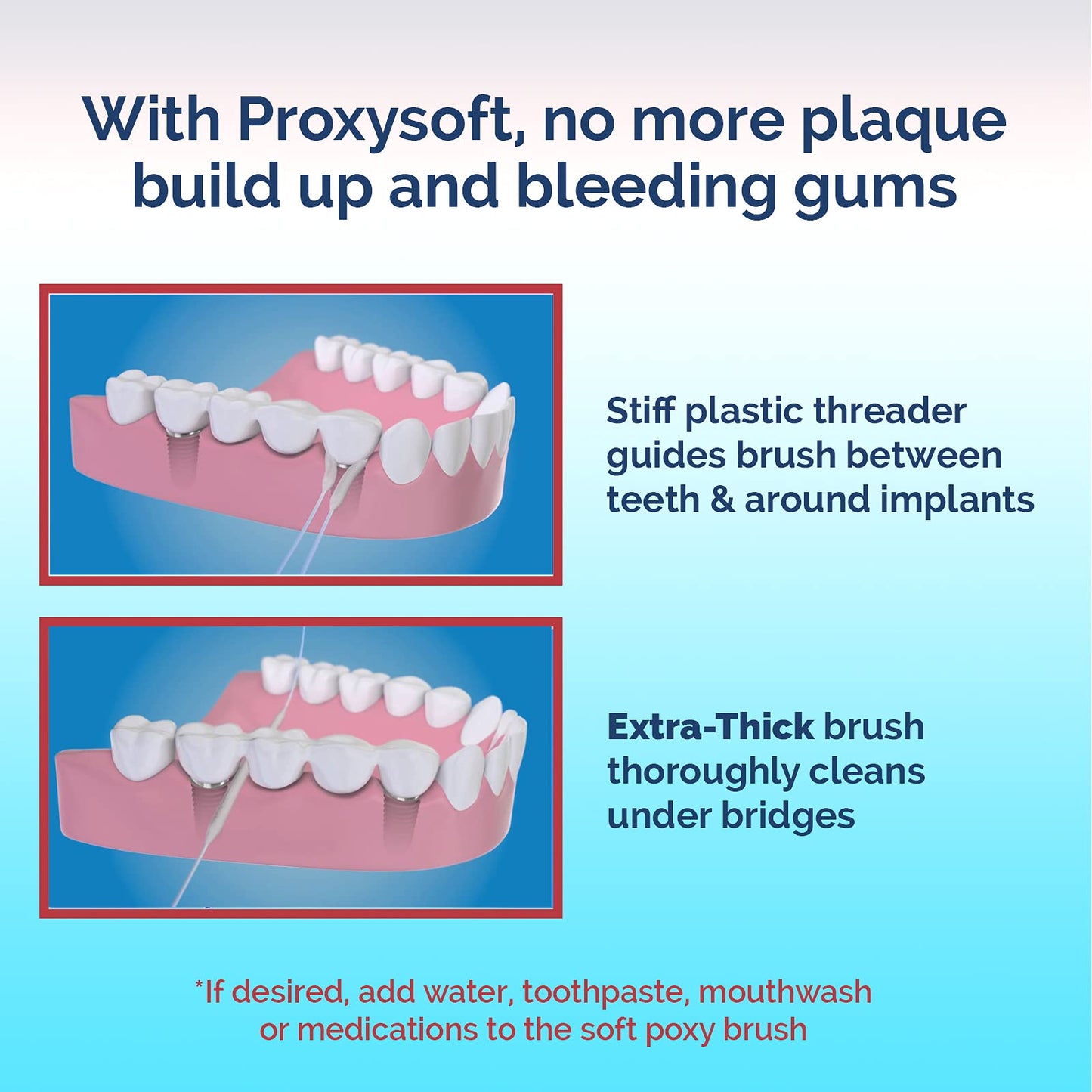 Proxysoft Dental Floss for Bridges and Implants 5 Packs - Floss Threaders for Bridges, Dental Implants, Braces with Extra-Thick Proxy Brush for Optimal Oral Hygiene -Teeth Bridge and Implant Cleaners