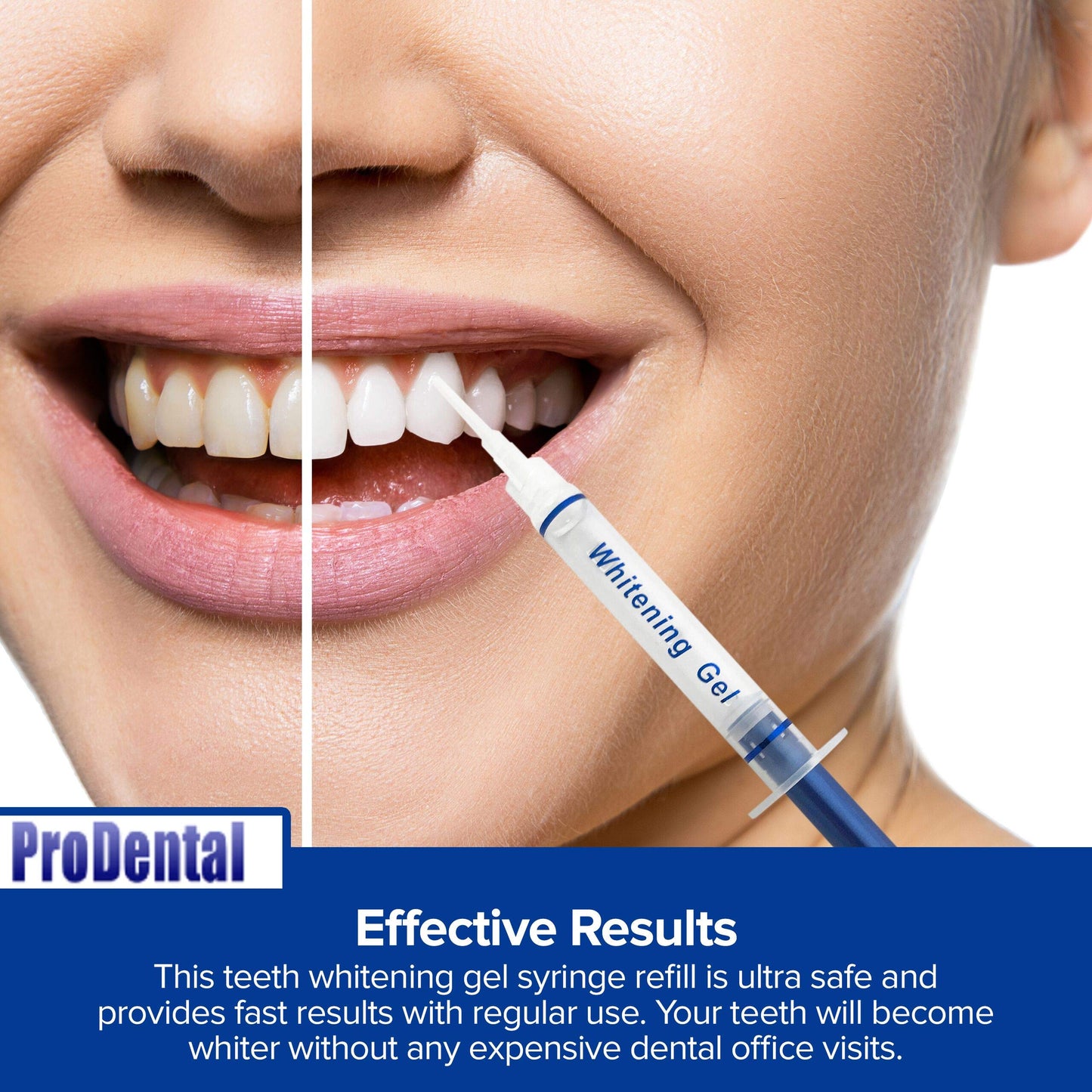 ProDental Teeth Whitening Gel Syringe Refill 8 Pack | 35% Carbamide Peroxide - 48 Treatments | Faster Results Than Tooth Whitening Strips - Pen - Powders and Toothpaste | Safe for Sensitive Teeth